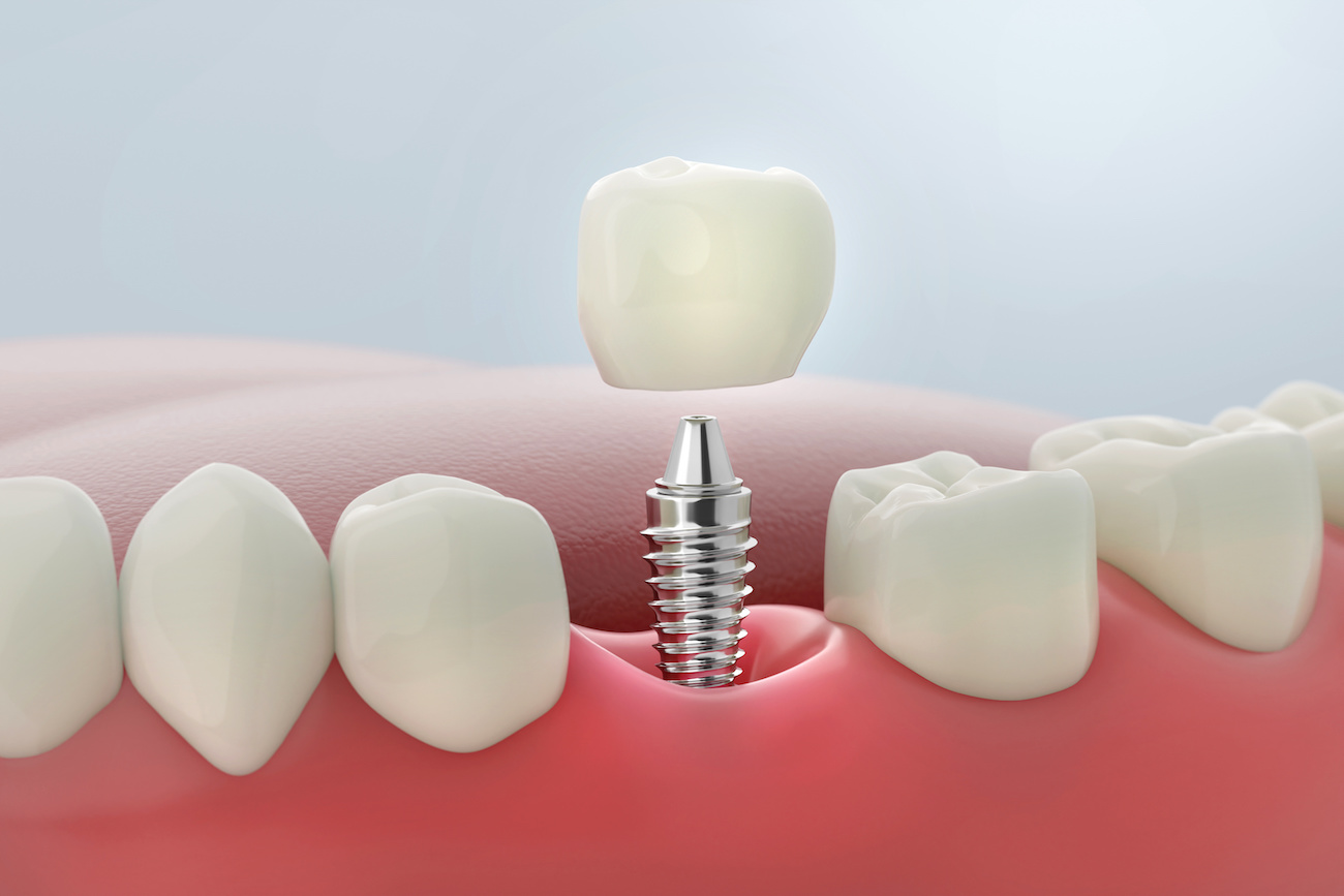 Featured image for “How Full Mouth Reconstruction Can Improve Your Dental Health”